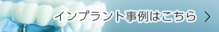 インプラント事例へリンク